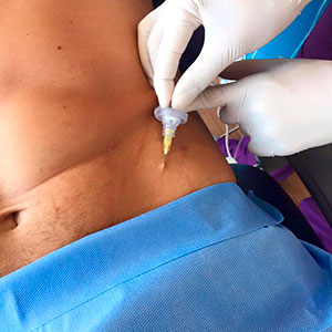 Carboxiterapia hombres