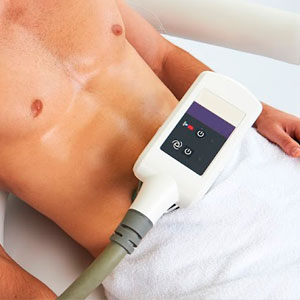 Criolipolisis hombres