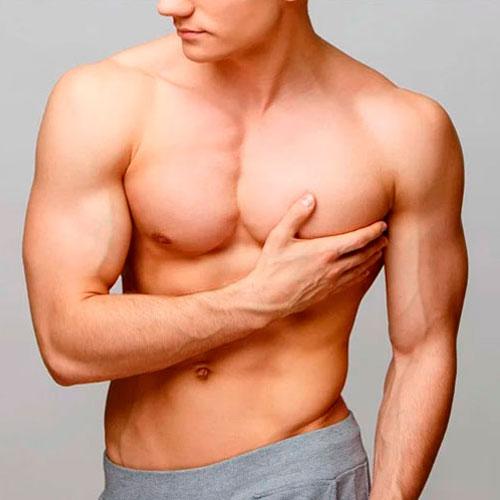 ginecomastia