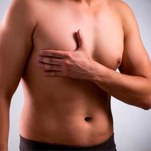 Ginecomastia hombres