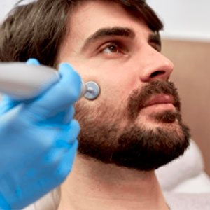 Radiofrecuencia facial hombres